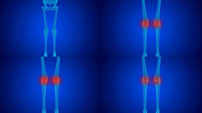 软骨磨损导致的蓝色全息膝关节疼痛。