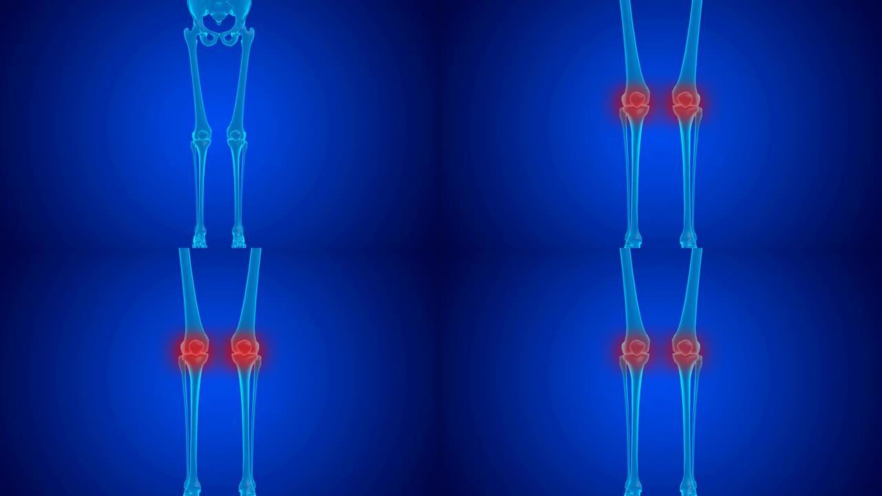 软骨磨损导致的蓝色全息膝关节疼痛。
