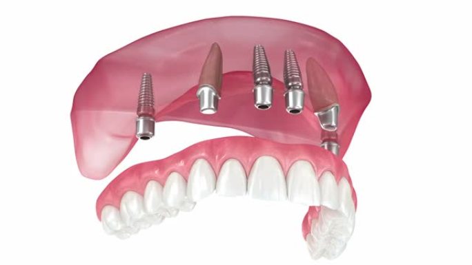 上颌假体由2颗牙齿和4颗植入物支撑。医学上精确的3D动画