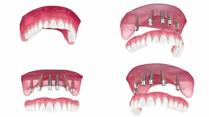 上颌假体由2颗牙齿和4颗植入物支撑。医学上精确的3D动画