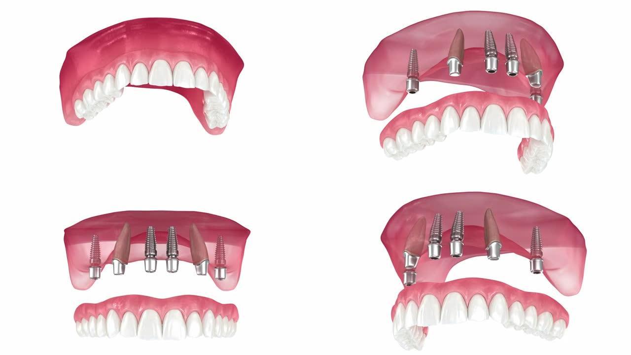 上颌假体由2颗牙齿和4颗植入物支撑。医学上精确的3D动画