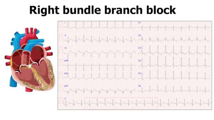 心电图右束支传导阻滞 (RBBB) 的心脏动画