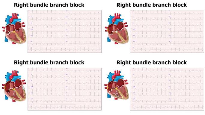 心电图右束支传导阻滞 (RBBB) 的心脏动画