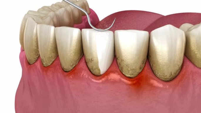 牙科治疗 (常规牙周治疗)。医学上精确的3D动画