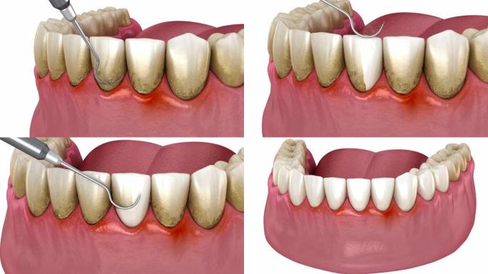 牙科治疗 (常规牙周治疗)。医学上精确的3D动画
