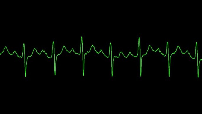 心电图显示窦性心动过速