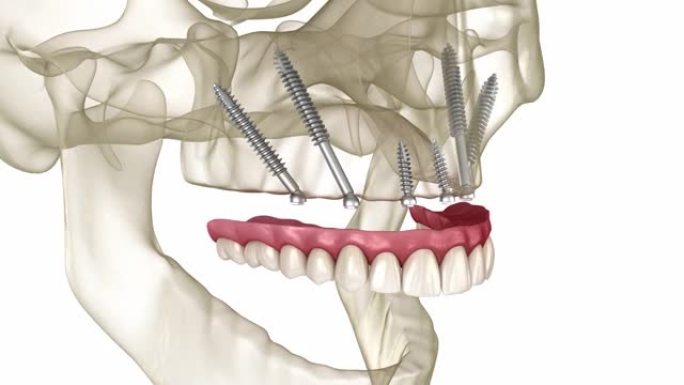 由颧骨植入物支撑的上颌假体。人体牙齿和假牙的医学精确3D动画