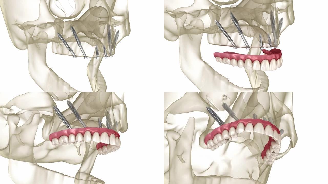 由颧骨植入物支撑的上颌假体。人体牙齿和假牙的医学精确3D动画