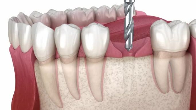 牙科植入物安装，定制基台和陶瓷冠。医学上精确的牙齿3D动画