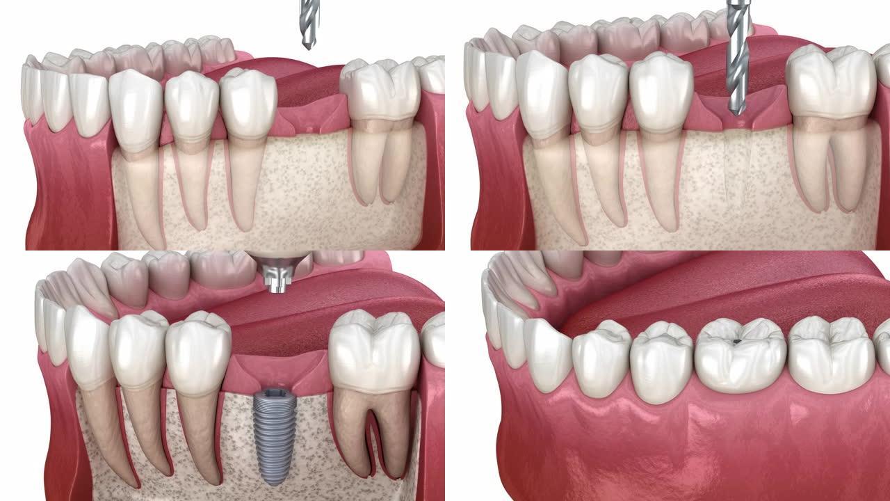 牙科植入物安装，定制基台和陶瓷冠。医学上精确的牙齿3D动画