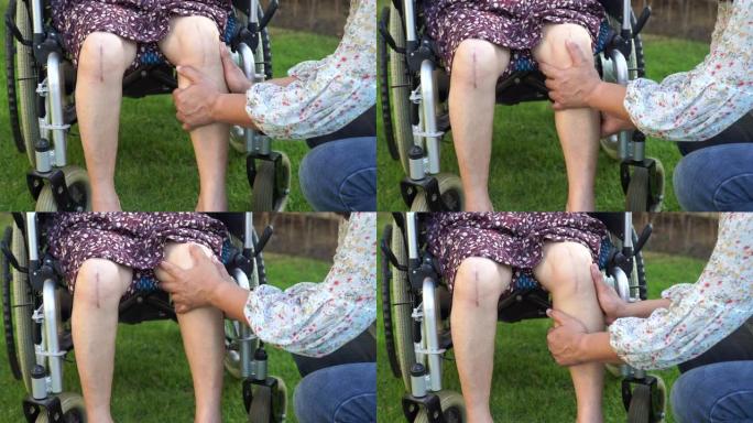 亚洲老年或老年老太太患者显示她的疤痕手术全膝关节置换缝合伤口手术关节置换术在轮椅护理医院病房: 健康