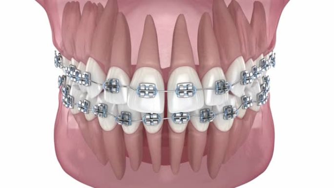 牙齿位置异常，用金属牙套矫正。医学上精确的牙科3D动画