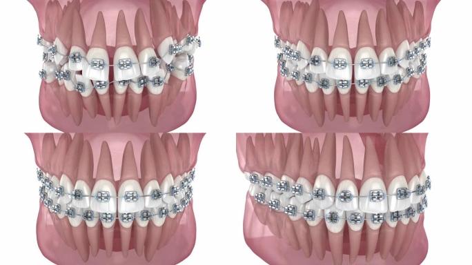 牙齿位置异常，用金属牙套矫正。医学上精确的牙科3D动画