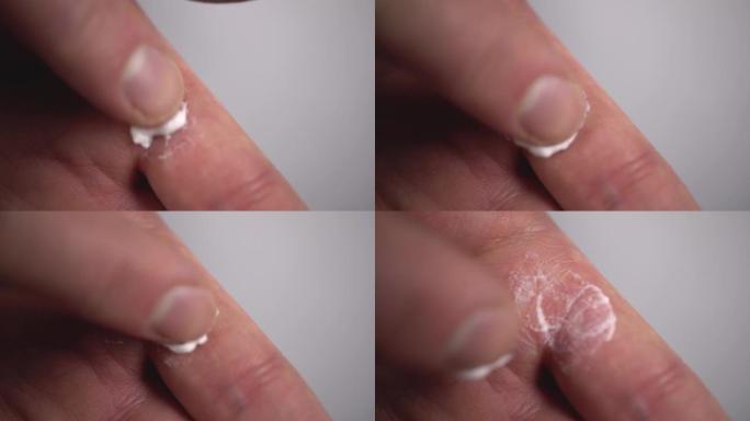 一个人用真菌的药膏涂抹他的手。手指上的玉米。特写。4k