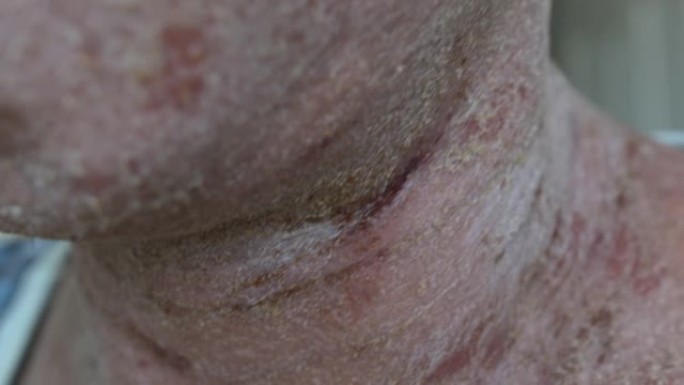湿疹患者的皮肤干燥