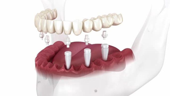 基于6种陶瓷植入物的牙科假体。牙科3D动画