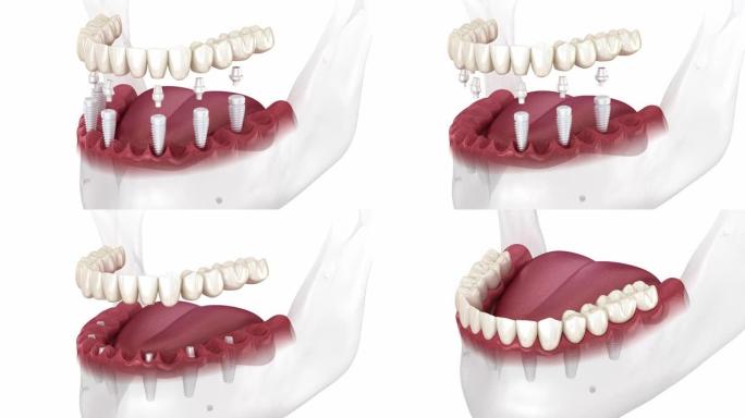 基于6种陶瓷植入物的牙科假体。牙科3D动画