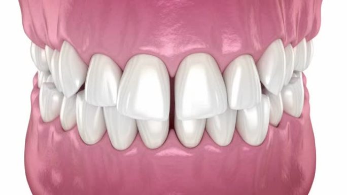 牙齿位置异常，矫正过程。医学上精确的牙科3D动画