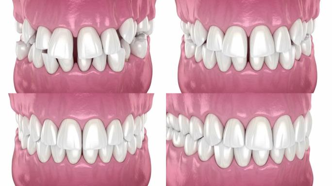 牙齿位置异常，矫正过程。医学上精确的牙科3D动画