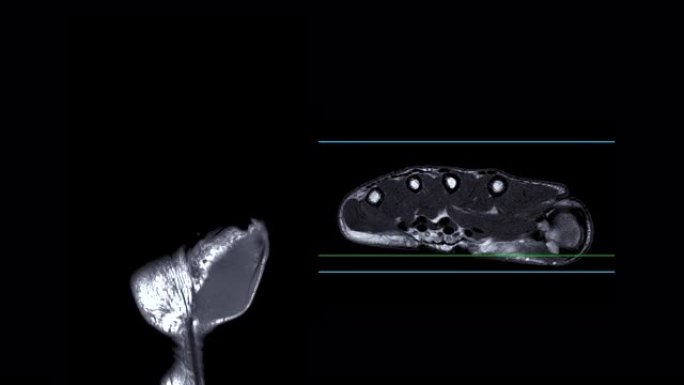 MRI手PDW用于诊断骨关节炎，类风湿和韧带撕裂。