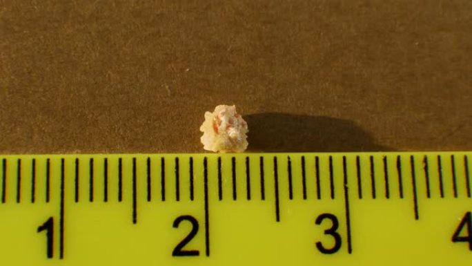 俯视图草酸盐结石从人体肾脏特写，用尺子测量结石的大小。人肾脏4毫米中的磷酸盐或尿酸盐结石。肾结石的检