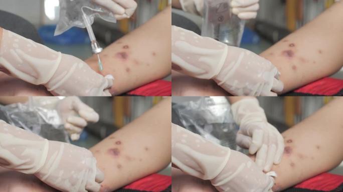 护士手部清洁病人足部溃疡充满脓液引起疥疮感染，敏感皮肤发痒健康问题