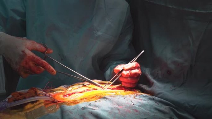 在医院手术室中进行冠状动脉旁路移植术CABG，以治疗由于冠心病而导致的心脏病。