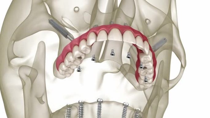 由颧骨植入物支撑的上颌和下颌假体。人体牙齿和假牙的医学精确3D动画