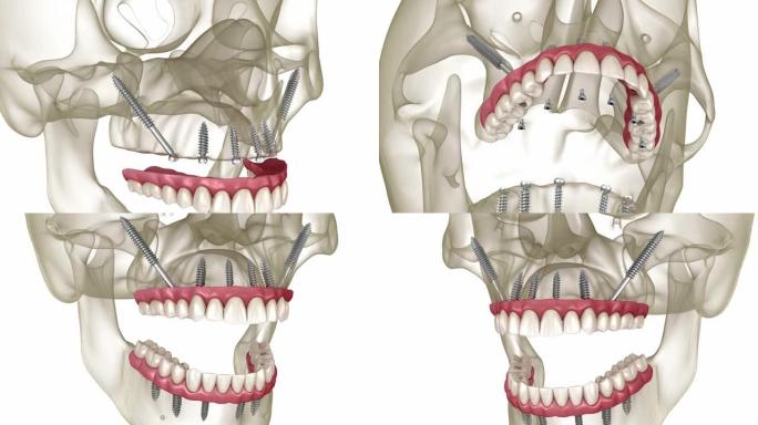 由颧骨植入物支撑的上颌和下颌假体。人体牙齿和假牙的医学精确3D动画