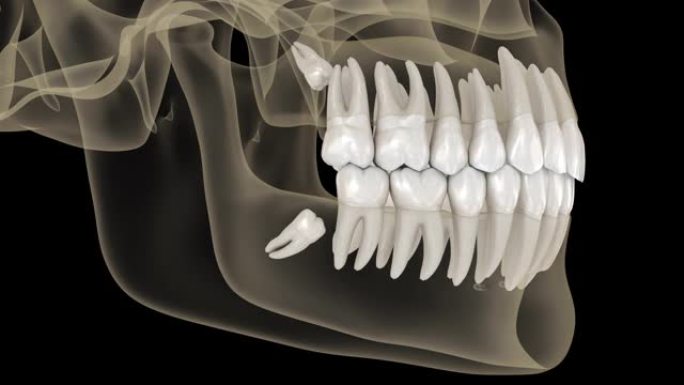 智齿对第二磨牙的近中嵌塞。医学上精确的牙齿3d动画