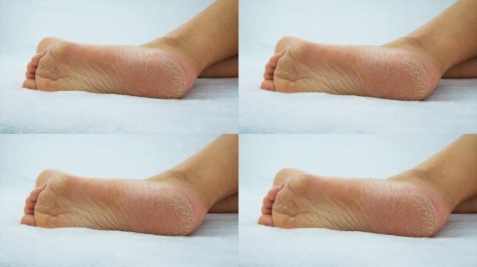 女性脚的皮肤干燥。选择性聚焦。人。