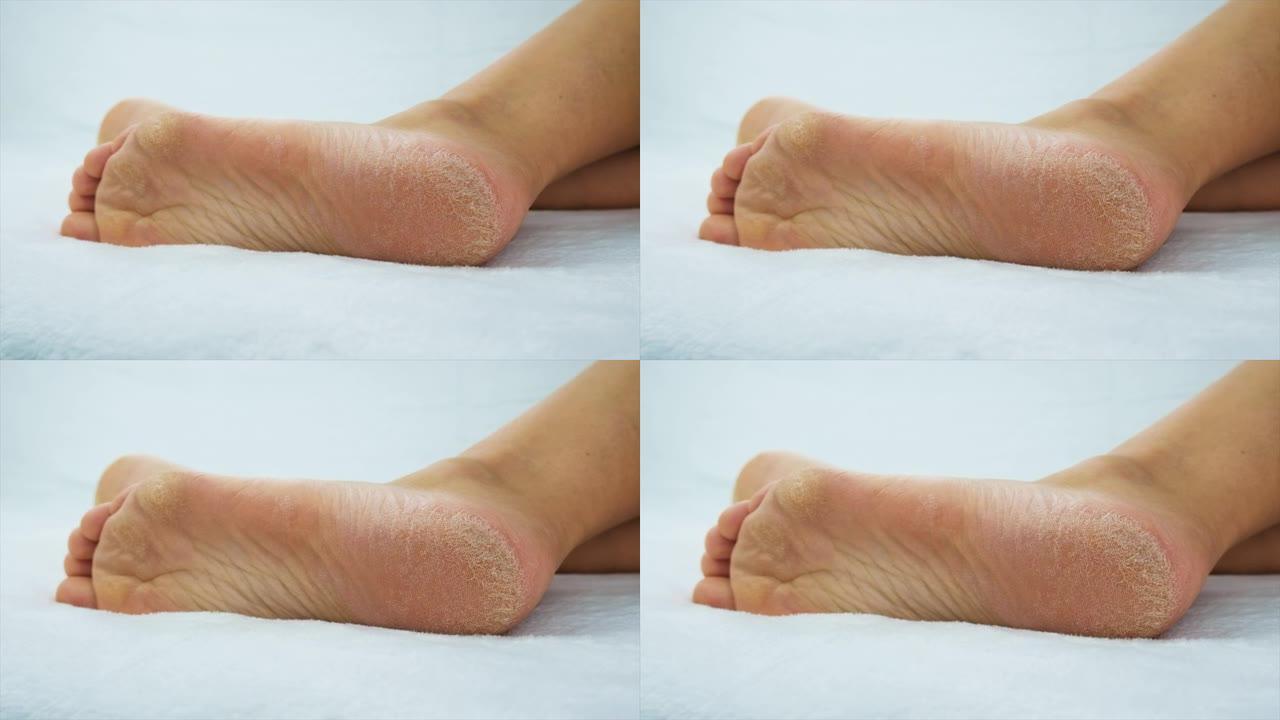 女性脚的皮肤干燥。选择性聚焦。人。
