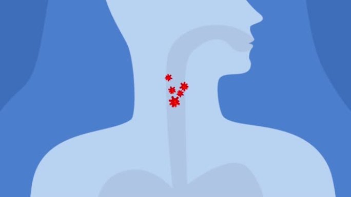 动画喉咙痛或喉咙里有细菌。疾病或感冒或流感病毒