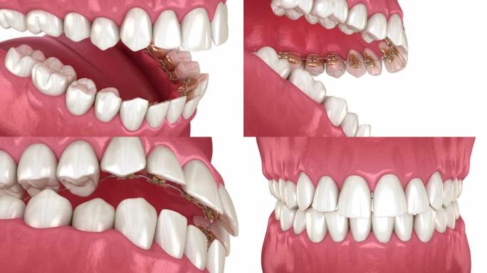 舌括号系统，咬合矫正。金色牙套的3D动画概念