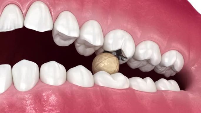 汞合金和牙齿破坏。医学上精确的牙科概念3D动画