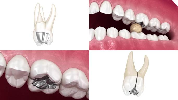 汞合金和牙齿破坏。医学上精确的牙科概念3D动画