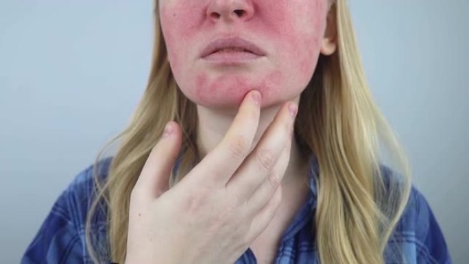酒渣鼻脸。这个女孩的脸颊发红。皮肤变形。面部可见发红和毛细血管网。治疗和移除。血管外科和皮肤科