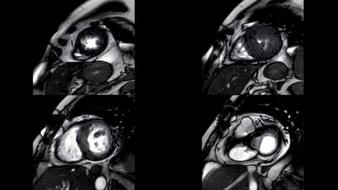 MRI心脏或心脏MRI (磁共振成像) 显示心脏跳动以检测心脏病。