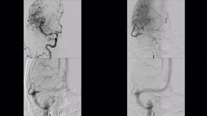 脑血管造影。