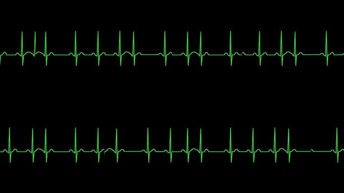 心电图显示窦性心律失常