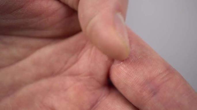 男人手指上的疣特写皮肤上的大愈伤组织。