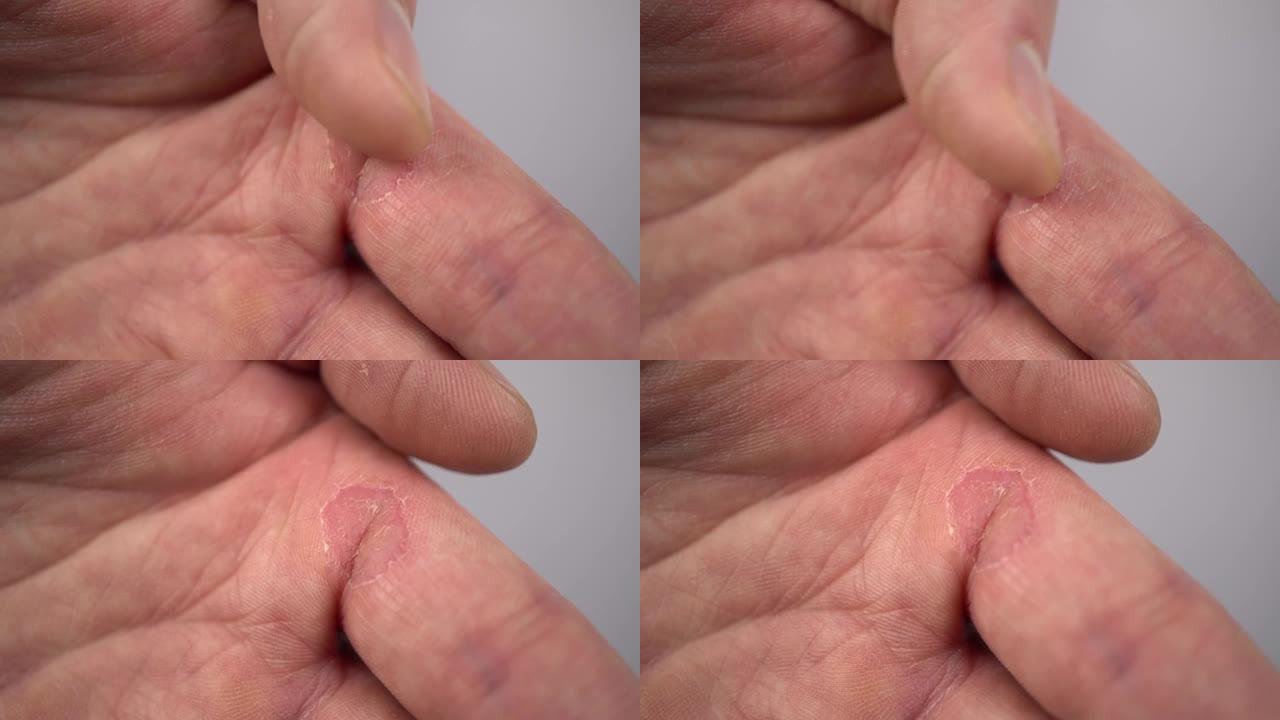 男人手指上的疣特写皮肤上的大愈伤组织。