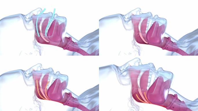 睡眠呼吸暂停综合征。标记鼻舌阻塞气道，3D动画