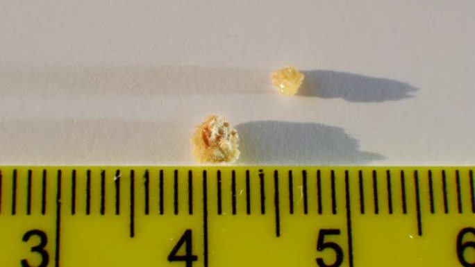 宏视频框架从人体肾脏中取出的石头，用尺子测量石头的大小。来自人类肾脏3毫米的磷酸盐或尿酸盐结石