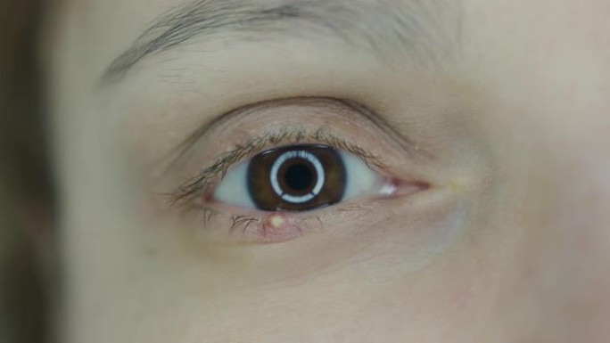 一个女人眼睛的特写。红眼睑伴有葡萄球菌感染的葡萄球菌感染。微距拍摄