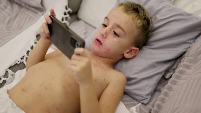 男孩，躺在床上，用手机玩电子游戏，而他的皮肤上长满了痘