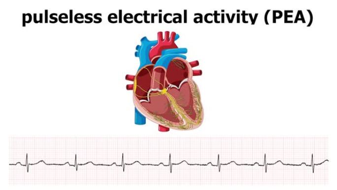 具有心电图脉冲电活动的心脏动画 (PEA)