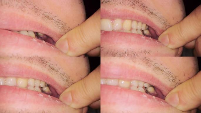 男人在手术后显示嘴里有黑线的接缝
