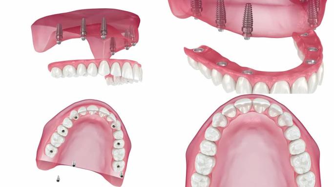 上颌假体与牙龈All on 6系统由植入物支撑。牙科3D动画
