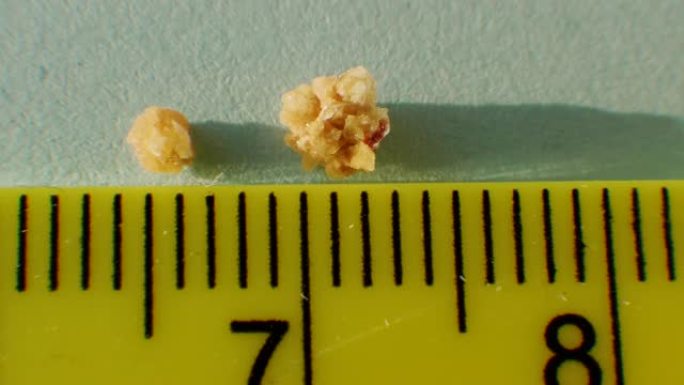 从人体肾脏近距离拍摄草酸盐结石，用尺子测量结石的大小。人肾脏4毫米中的磷酸盐或尿酸盐结石